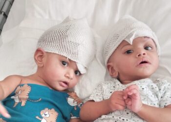 Rare conjoined twin girls separated after 14 hour operation | UK News