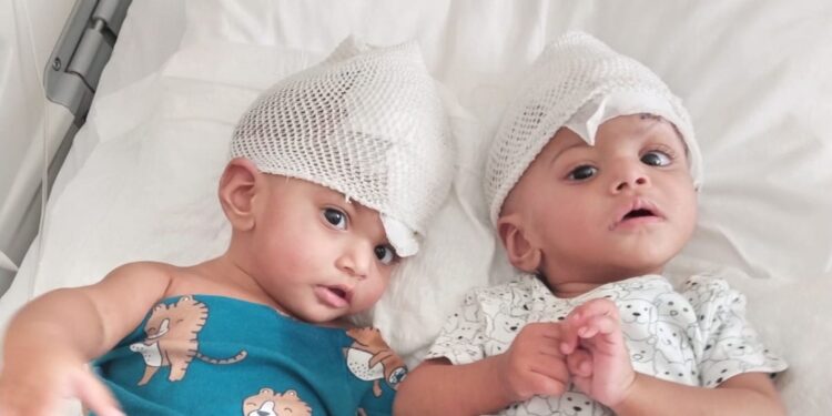 Rare conjoined twin girls separated after 14 hour operation | UK News