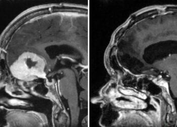 Surgeon removes large brain tumours through patients’ eyebrows in ‘world first’ | UK News