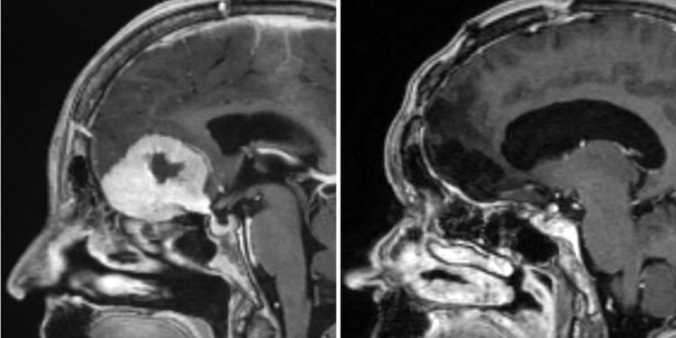 Surgeon removes large brain tumours through patients’ eyebrows in ‘world first’ | UK News