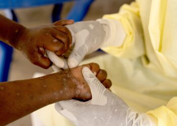 How is new strain of mpox found in UK different to what we’ve had before? | UK News