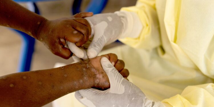 How is new strain of mpox found in UK different to what we’ve had before? | UK News